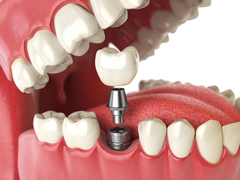 implant dentar bucuresti, implantologie bucuresti, cmi dr cruceru anda