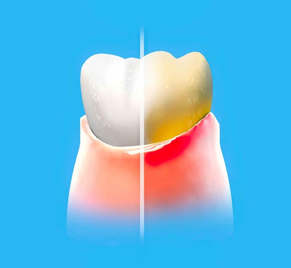 parodontoza bucresti, tratament parodontoza bucresti, dinti mobili, parodontologie bucuresti